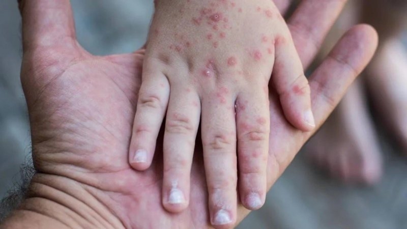Ante riesgo de sarampión, adelantan la segunda dosis de la vacuna Triple Viral